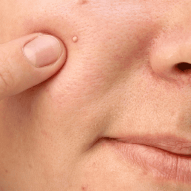 Niacinamida: Sua Aliada no Controle da Oleosidade e Textura da Pele - inspiração 3