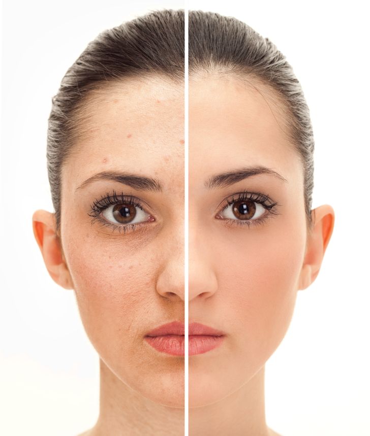 Laser CO2 Fracionado: O Upgrade Definitivo para uma Pele Renovada - inspiração 1