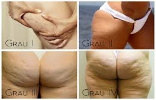 Massagem Modeladora DIY: Suas Mãos São Suas Melhores Ferramentas - inspiração 1