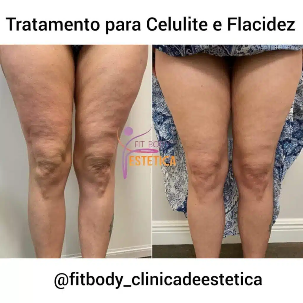 Massagem Modeladora DIY: Suas Mãos São Suas Melhores Ferramentas - inspiração 3