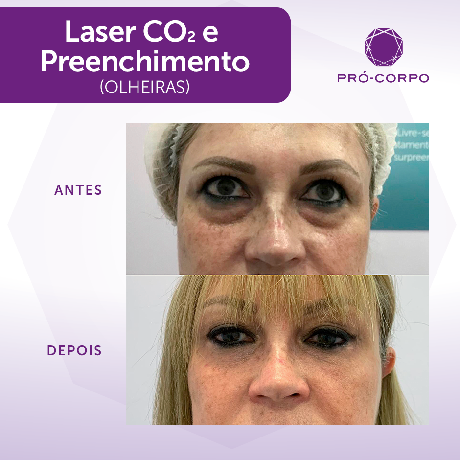 Ácido Hialurônico: Hidratação Profunda para Olheiras Fundas - inspiração 2