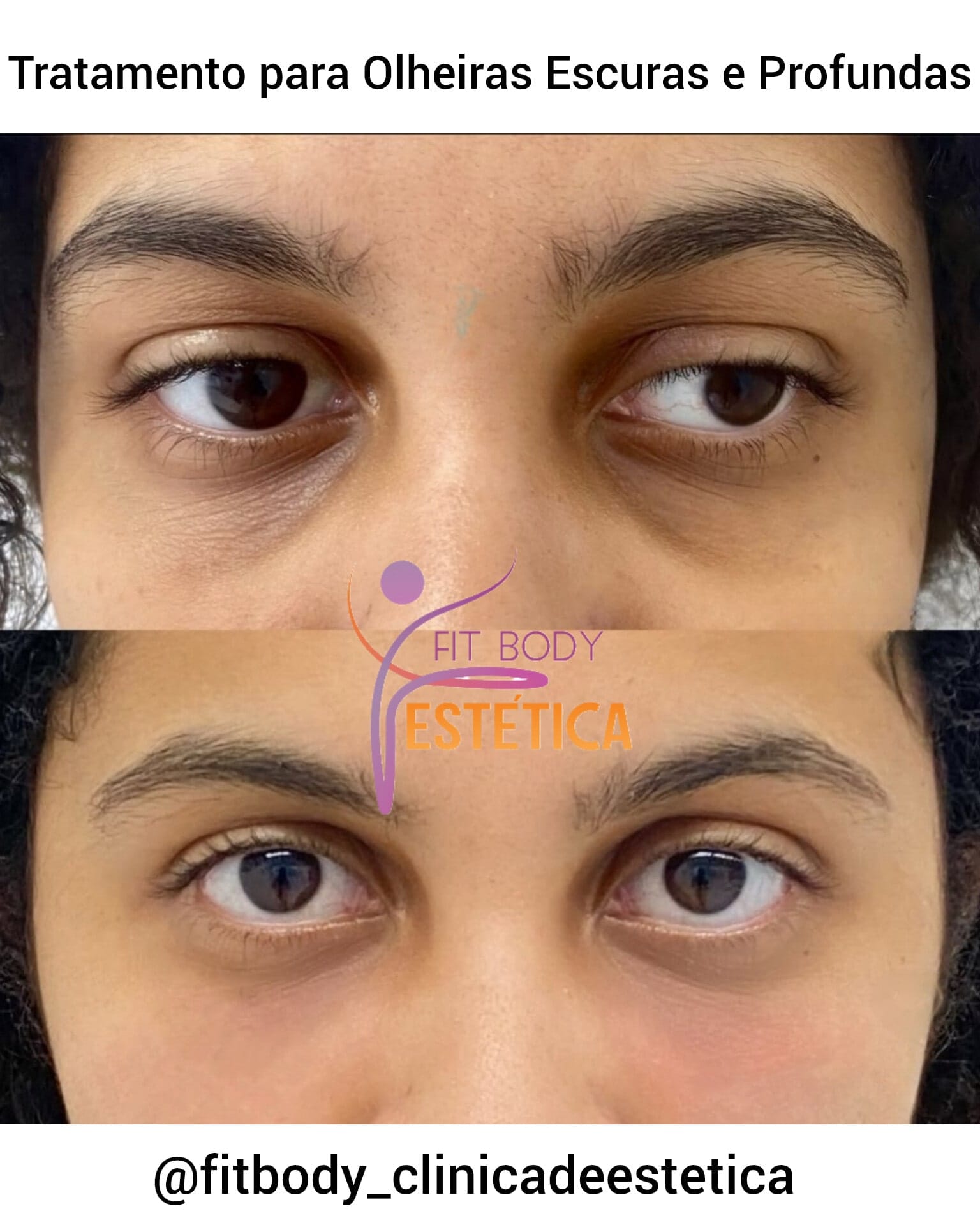 Cafeína: Despertando a Microcirculação na Área dos Olhos - inspiração 2