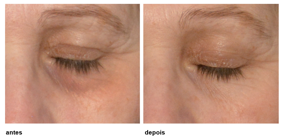 Laser Fotona: Tecnologia a Favor da Sua Beleza - inspiração 2