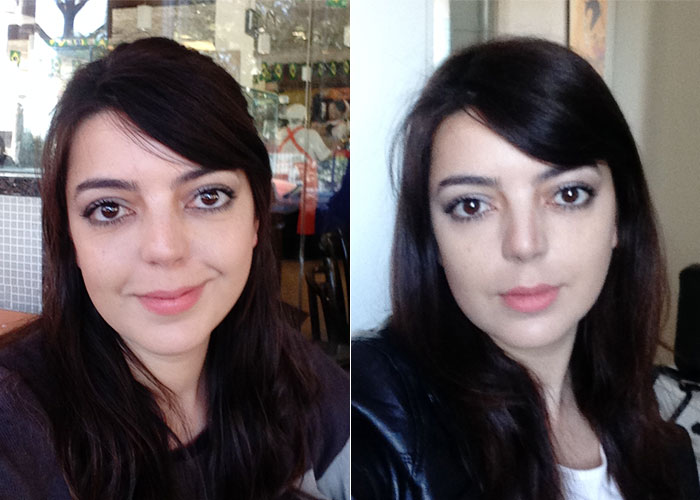 Preenchimento com Ácido Hialurônico: Volume e Contorno Restaurados - inspiração 3