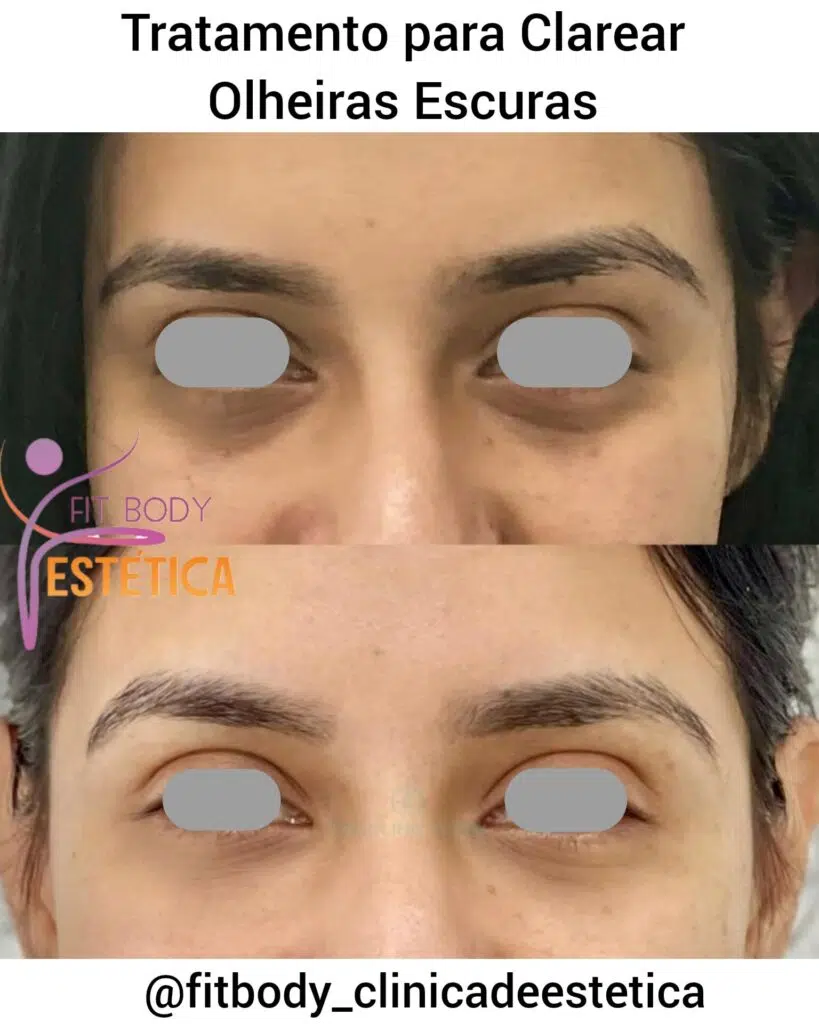 Microagulhamento: Estimulando o Colágeno para uma Pele Mais Firme - inspiração 3