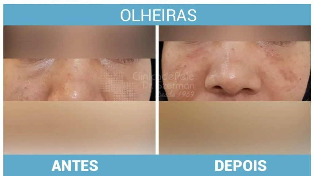 Compressas Frias: Um Truque Simples e Eficaz - inspiração 1