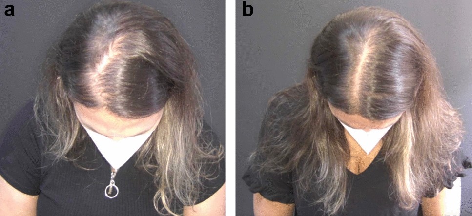 Clascoterona: A Nova Esperança Tópica Contra a Ação Hormonal - inspiração 1