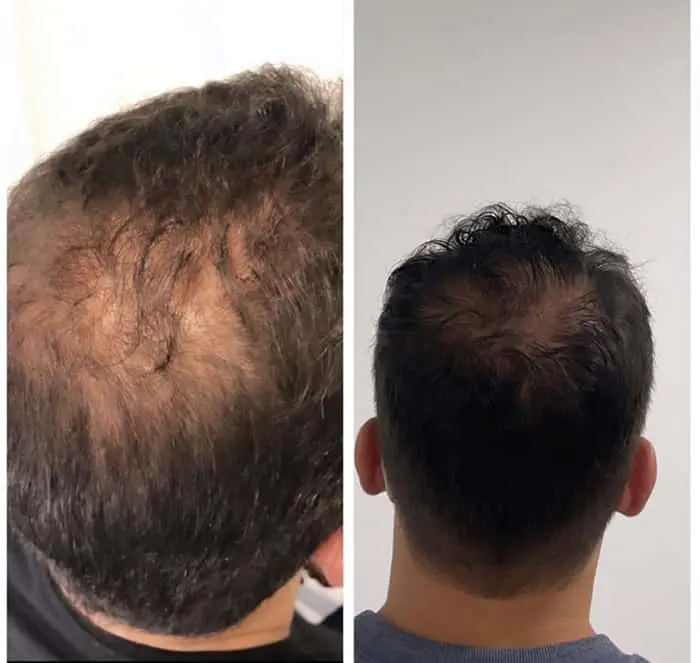 Molécula PP405: O Futuro da Regeneração Capilar ao Seu Alcance - inspiração 3