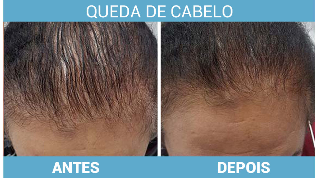 Microagulhamento (MMP): A Farmácia Direto no Couro Cabeludo - inspiração 1