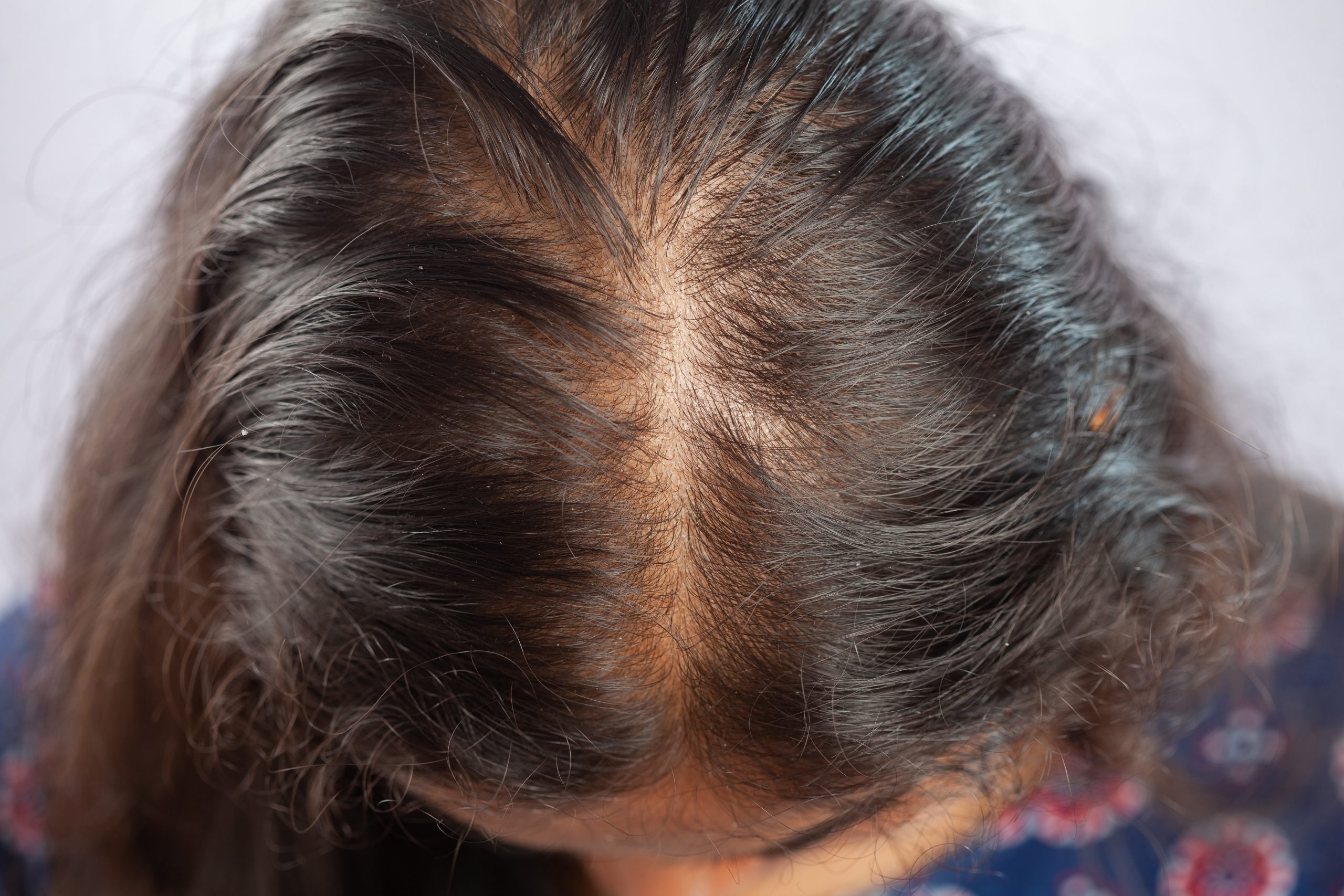 Desvendando os Tipos Comuns de Alopecia em Mulheres - inspiração 1