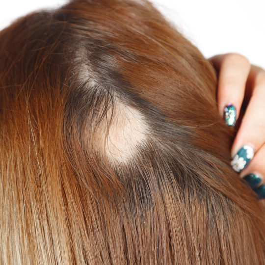 Vivendo Bem com a Alopecia: Dicas de Empoderamento e Autoestima - inspiração 1