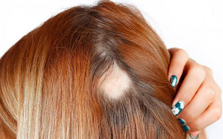 Tratamentos Modernos para Combater a Alopecia - inspiração 2
