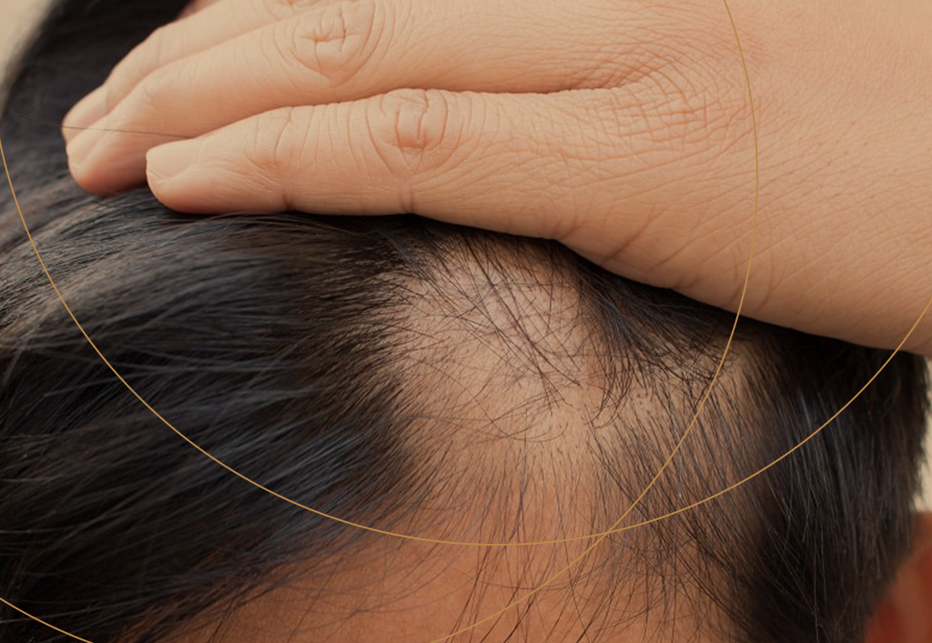 Avanços em Transplante Capilar e Outras Técnicas Cirúrgicas - inspiração 1