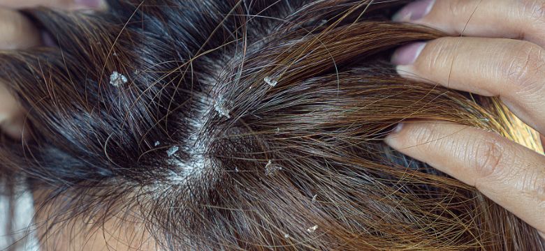 Condicionadores e Máscaras: Hidratação Essencial para o Alívio - inspiração 2