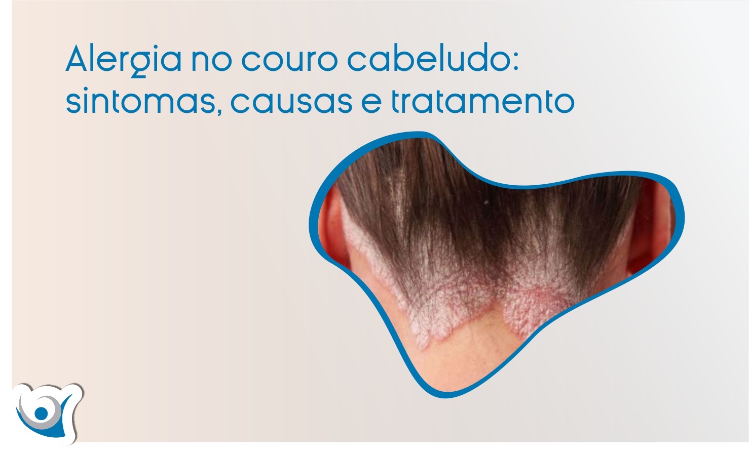 Evitando Gatilhos: Identificando e Fugindo de Irritantes Comuns - inspiração 2