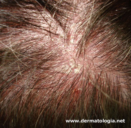 Dicas Práticas Para Manter o Couro Cabeludo Saudável no Dia a Dia - inspiração 1