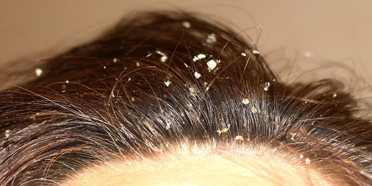 Tratamentos Tópicos: Receitas e Formulações que Ajudam no Controle - inspiração 1