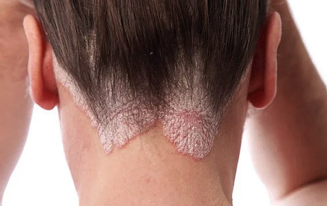 Tratamentos Tópicos: Receitas e Formulações que Ajudam no Controle - inspiração 2