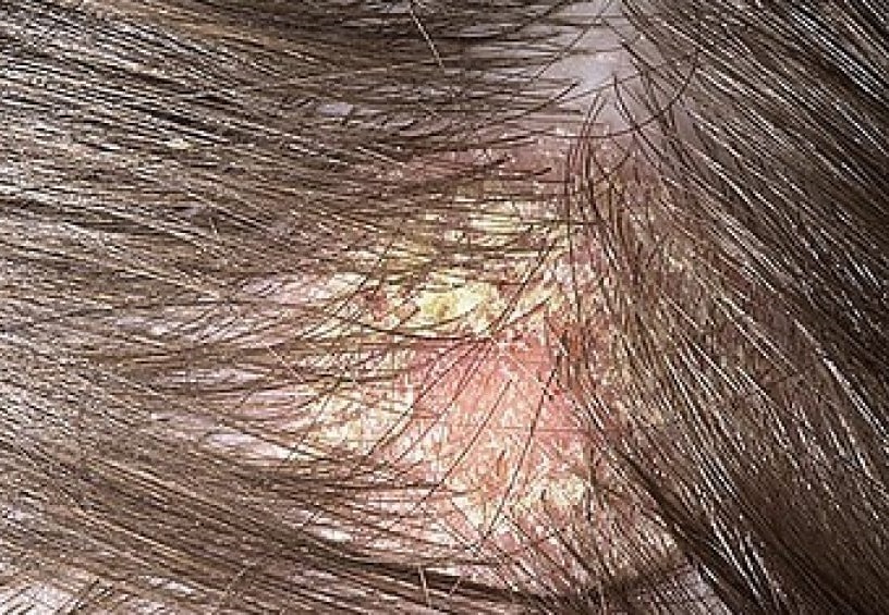 Quando Procurar Ajuda Profissional: O Papel do Dermatologista - inspiração 1