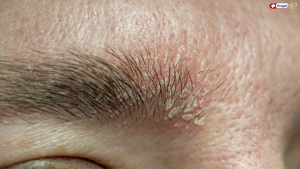 Quando Procurar Ajuda Profissional: O Papel do Dermatologista - inspiração 2