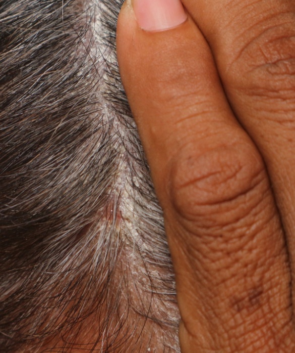 Mitos e Verdades Sobre a Caspa e a Dermatite Seborreica - inspiração 1