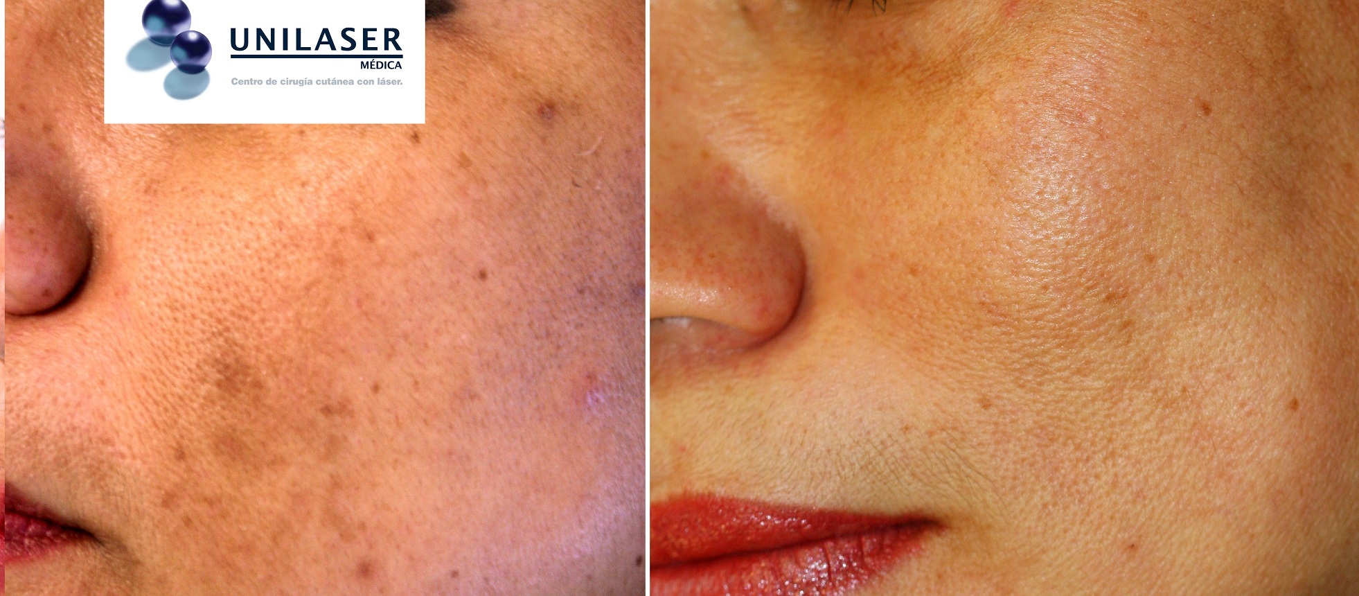 Quem Não Pode Fazer Laser? Contraindicações Que Você Precisa Saber - inspiração 2