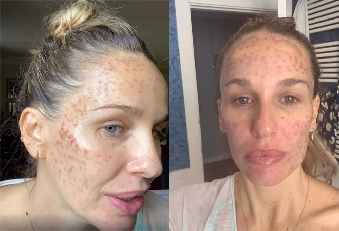 Tipos de Laser Para Manchas: Qual o Ideal Para Você? - inspiração 1