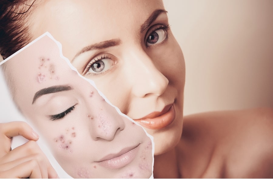 Cuidados Pós-Laser: O Que Esperar e Como Recuperar Sua Pele? - inspiração 1