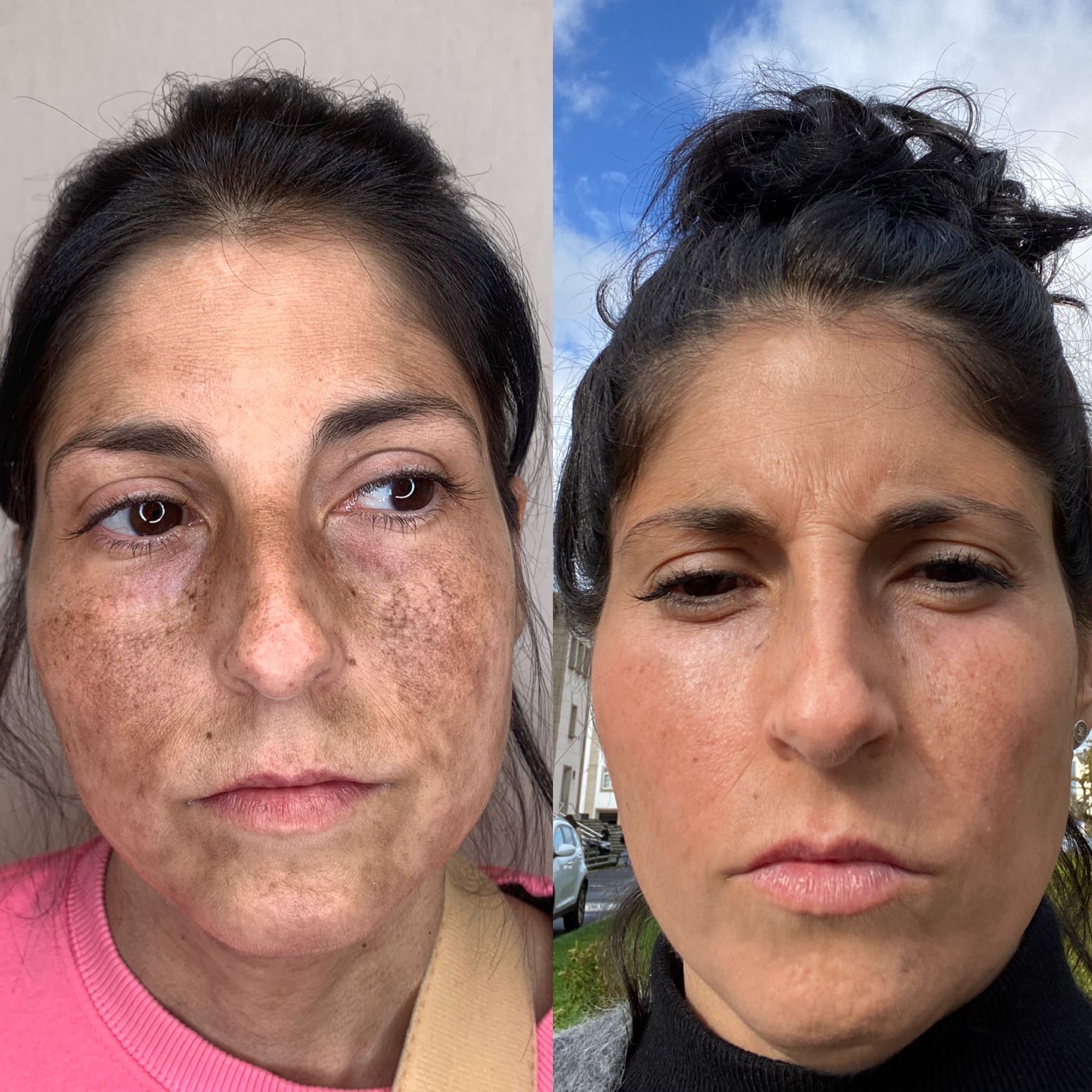 Cuidados Pós-Laser: O Que Esperar e Como Recuperar Sua Pele? - inspiração 2