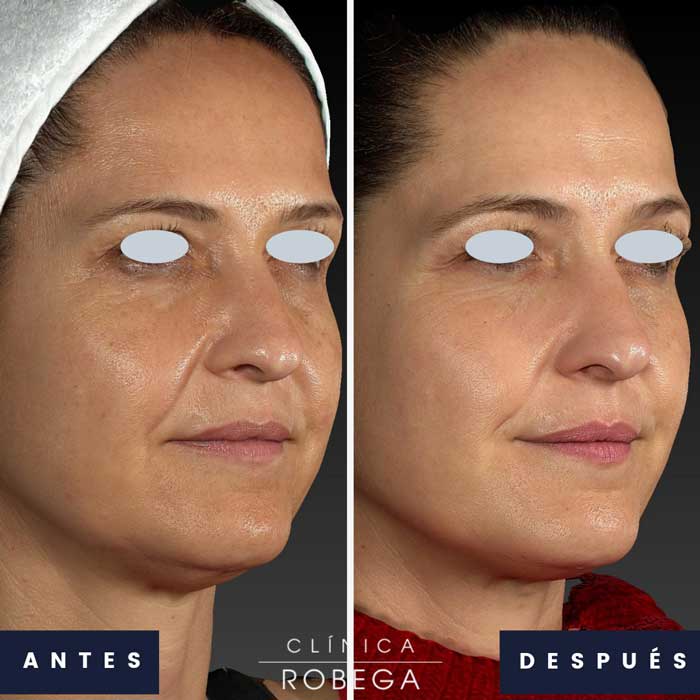 Diferenças Entre Laser e Outros Tratamentos: Vantagens e Desvantagens - inspiração 1