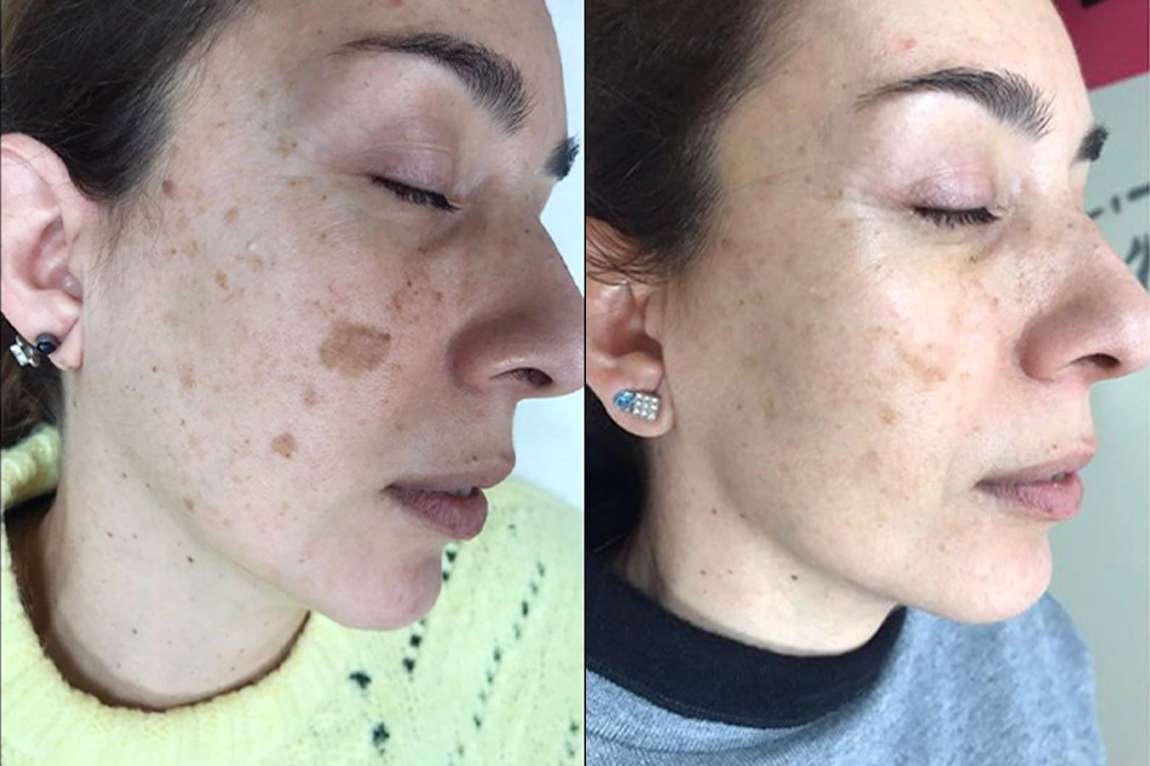 A Dor é Grande? Entenda a Sensação Durante o Tratamento - inspiração 2