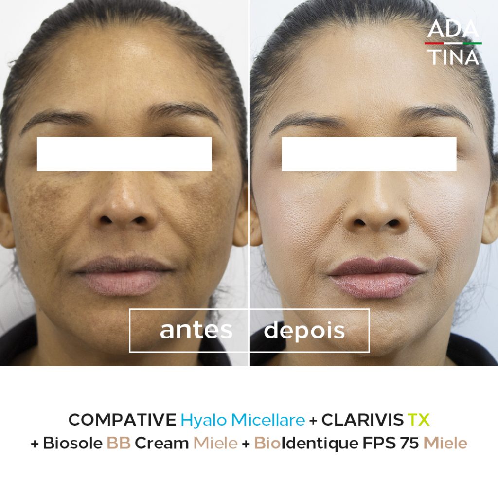 Protetor Solar com Cor: Seu Aliado Diário Contra o Melasma - inspiração 1