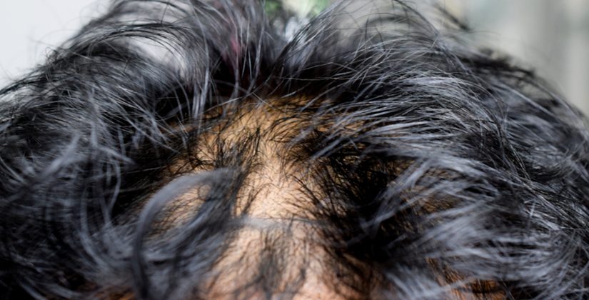 Entendendo a Produção de Sebo: A Ciência por Trás da Oleosidade - inspiração 1