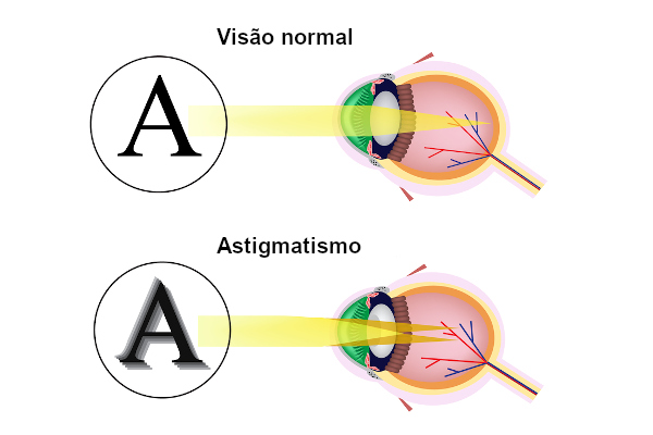 astigmatismo