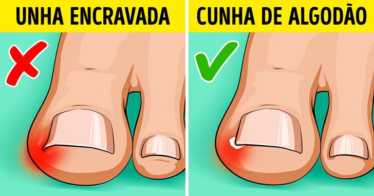 como evitar unhas encravadas em crianças desenho