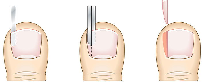 melhores formas evitar unha encravada crianca