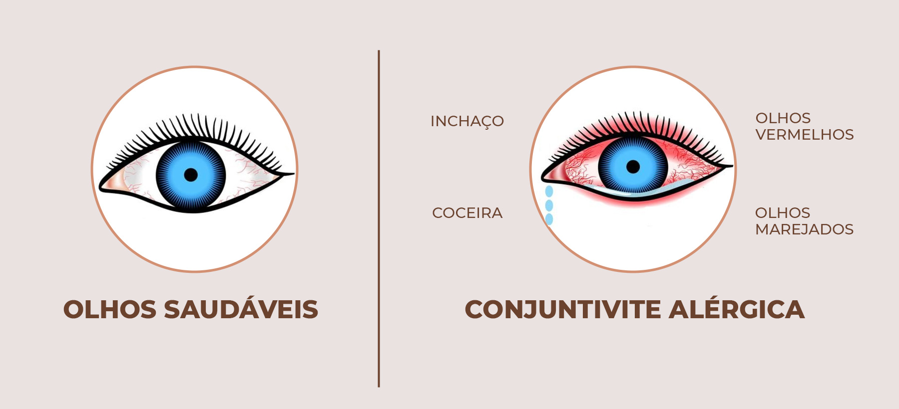 sintomas conjuntivite alérgica vs viral