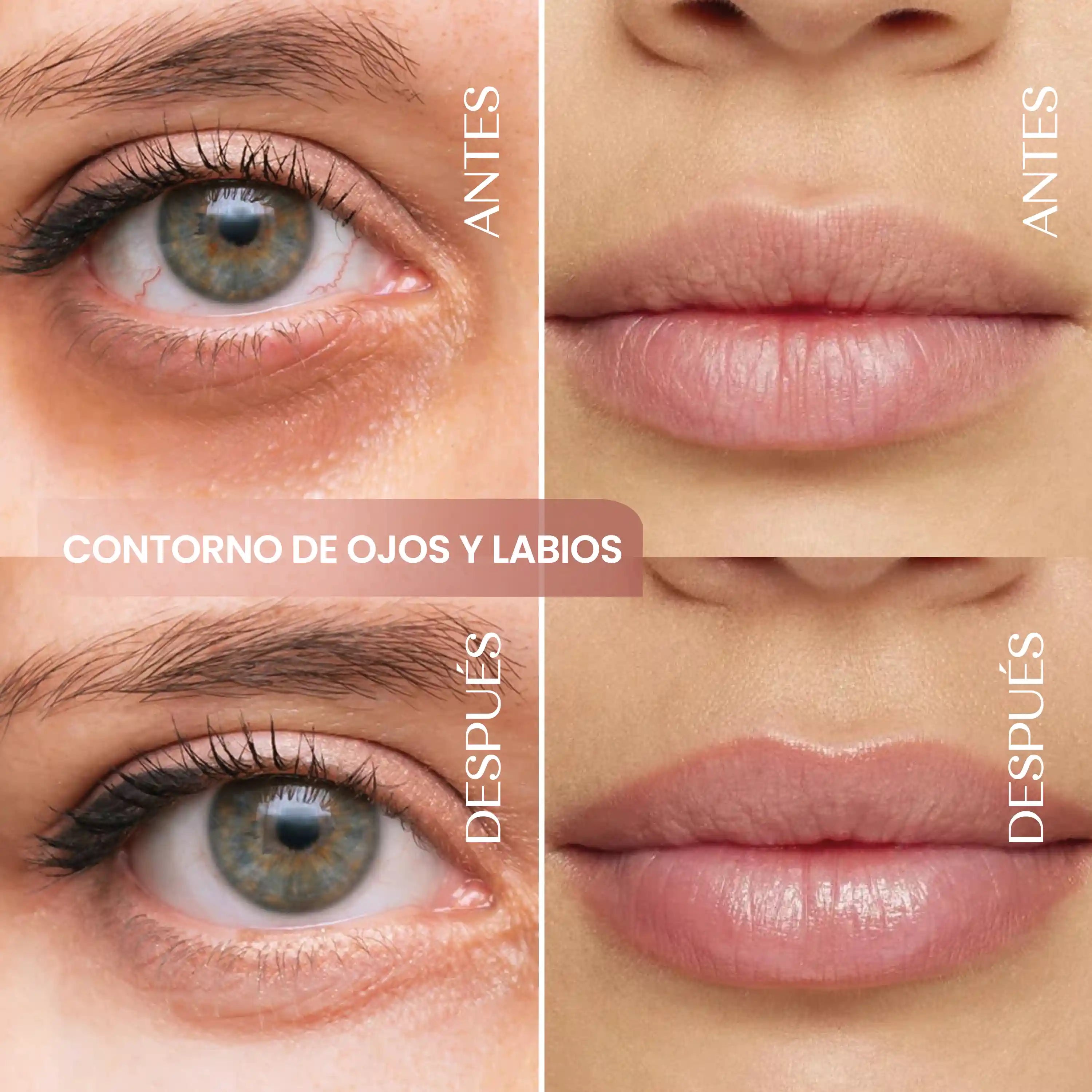 Mitos e Verdades sobre a Durabilidade do Preenchimento Labial com Ácido Hialurônico