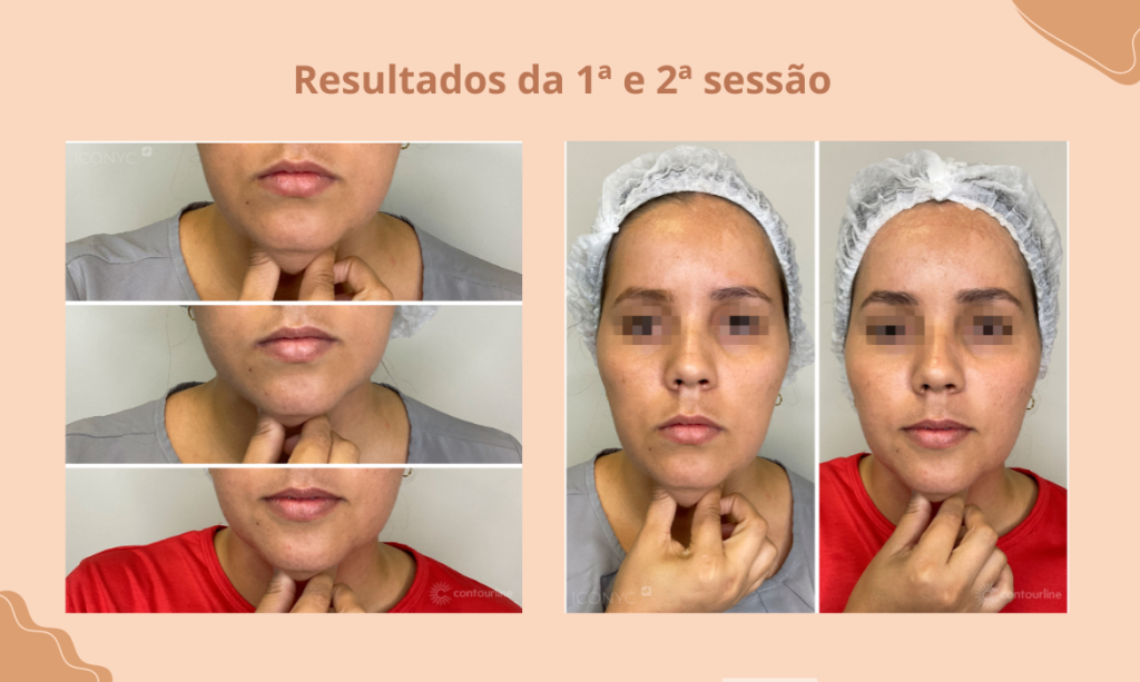 Criofrequência rosto preço sessão