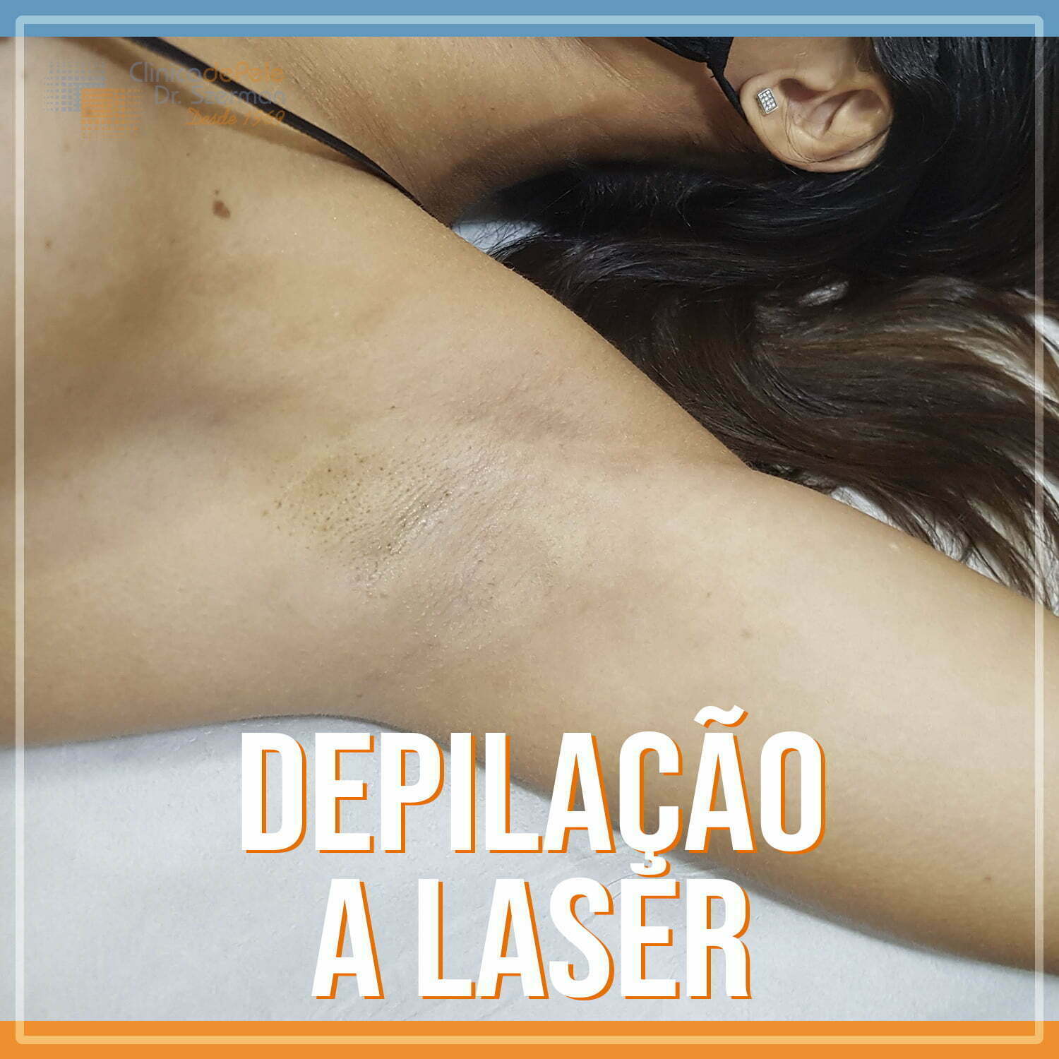 Depilação a Laser: Mitos e Verdades sobre a Dor