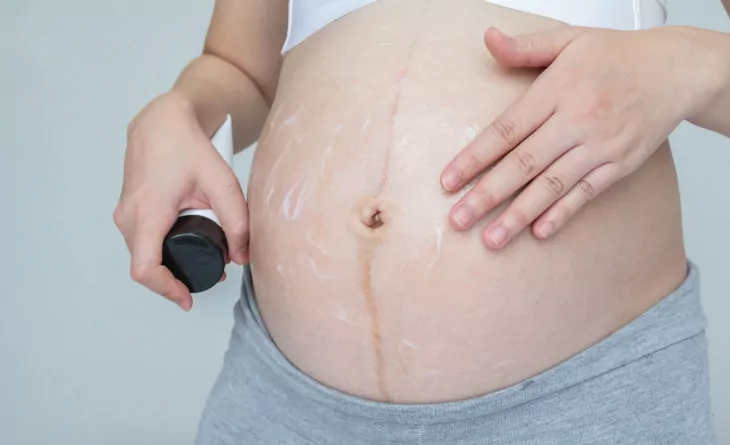 Estrias Pós-Parto: Mitos e Verdades sobre Tratamentos Eficazes