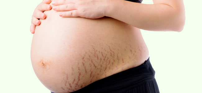 Dieta e Hidratação: O Segredo para Prevenir Estrias na Gestação