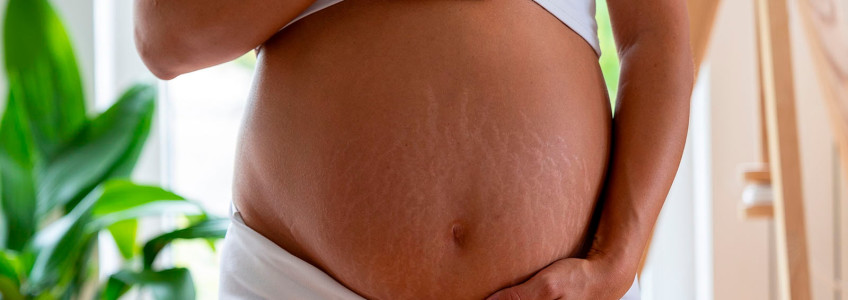 Guia Completo: Como Escolher o Melhor Creme para Estrias na Gravidez