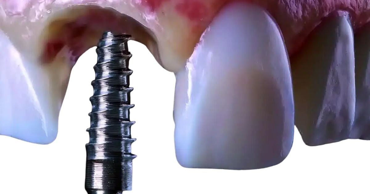 Implante Dentário: Carga Imediata Vale a Pena? Guia Completo de Preços e Benefícios