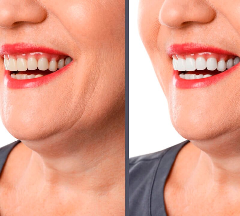 Marcas de Implantes Dentários: Comparativo de Preços e Qualidade (Straumann