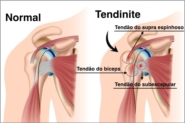 melhores exercícios para tendinite no ombro