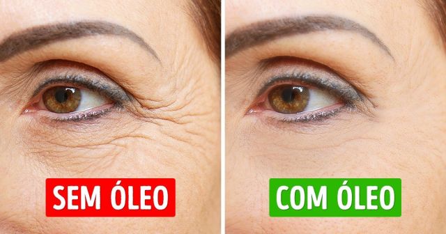 Dermatite seborreica e psoríase: Tratamentos complementares e cuidados com a pele