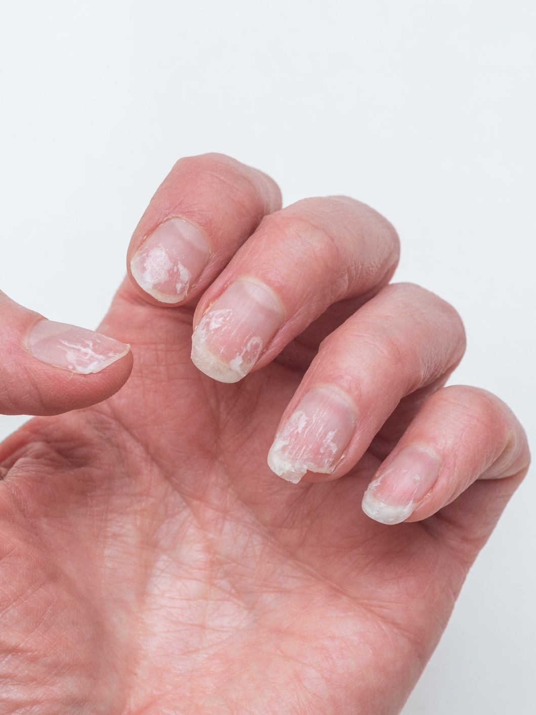 por que minhas unhas quebram e descamam o que fazer