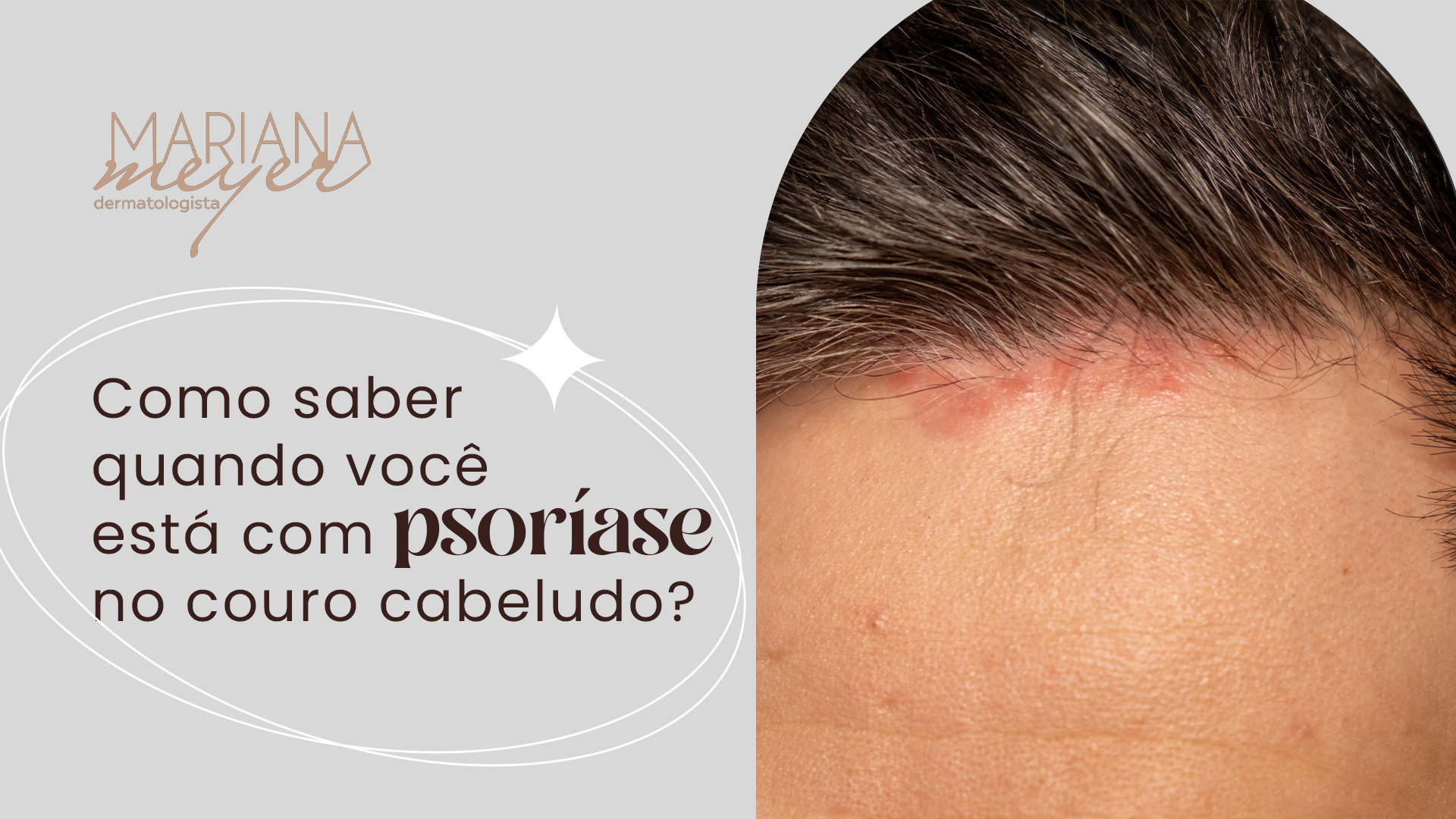 psoríase no couro cabeludo