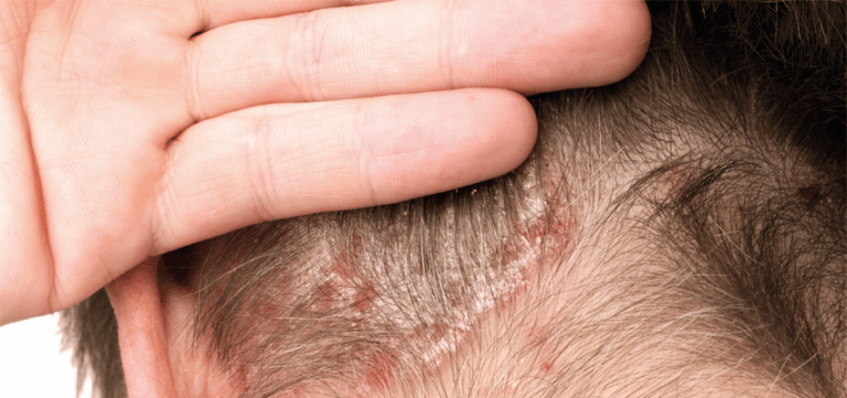 Psoríase vs. Dermatite Seborreica: Entenda as Diferenças e Saiba Identificar